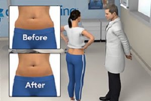 Marietta GA Non-Surgical Fat Reduction