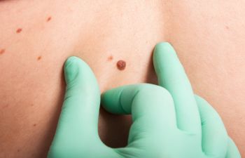 Mole Inspection Skin Cancer Marietta, GA