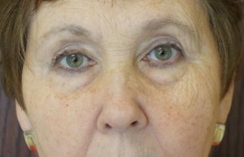 female patient after upper blepharoplasty