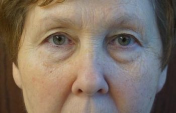 female patient before upper blepharoplasty