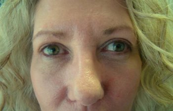 female patient after blepharoplasty