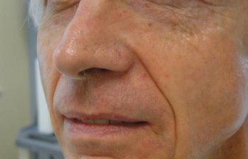 patient after upper lip Mohs surgery