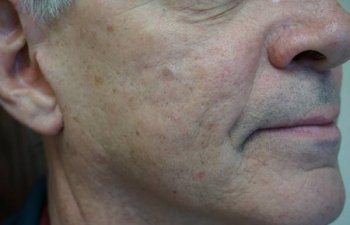 middle-aged male patient with acne scarring after Bellafill treatment