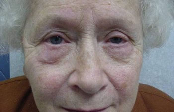 female patient after blepharoplasty