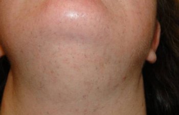 female patient before chin hair laser removal