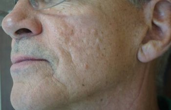 middle-aged male patient with acne scarring before Bellafill treatment