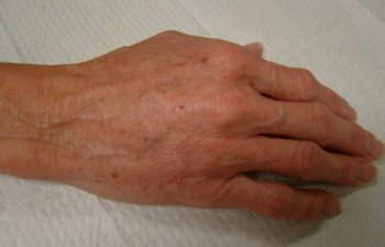 hands after Radiesse treatment