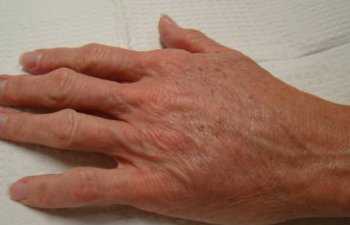 hands after Radiesse treatment