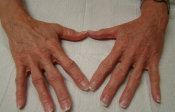 hands after Radiesse treatment