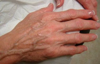 hands before Radiesse treatment