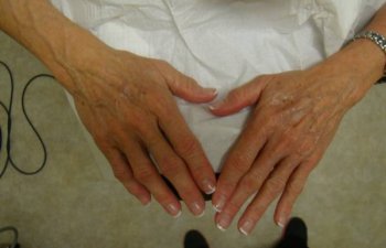 hands before Radiesse treatment