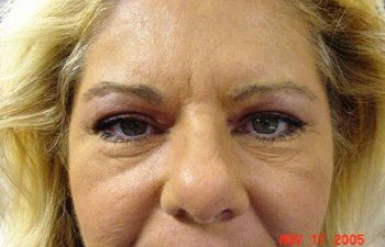 female patient after blepharoplasty