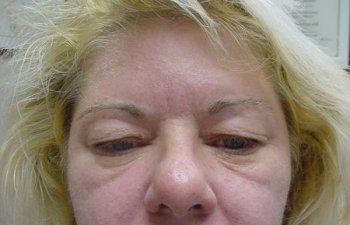 female patient before blepharoplasty