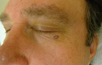 Mohs - Left Lower Eyelid