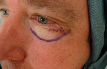 male patient after left lower eyelid Mohs surgery