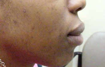 female patient after chemical peel treatment