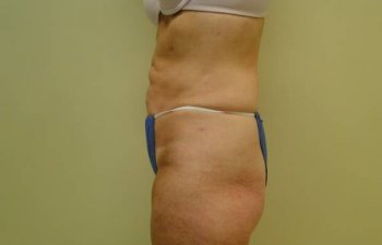 female patient after tumescent liposuction