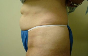 female patient before tumescent liposuction