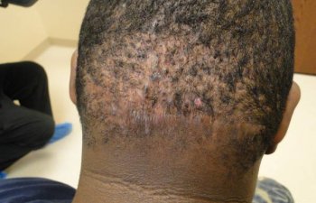 patient after head keloid treatment