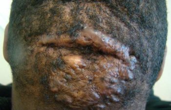 patient before head keloid treatment