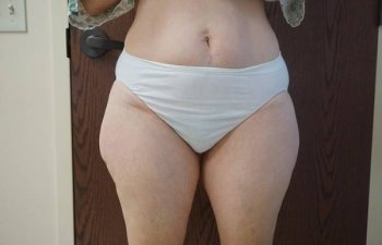 female outer thighs before liposuction