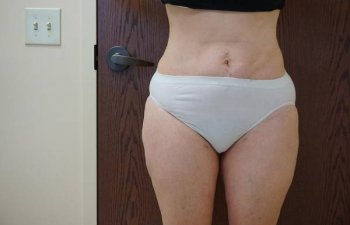 female patient before outer thighs liposuction