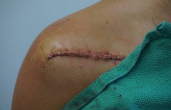 patient after surgical tattoo removal