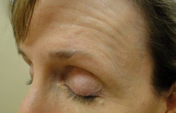 female patient after left brow Mohs surgery