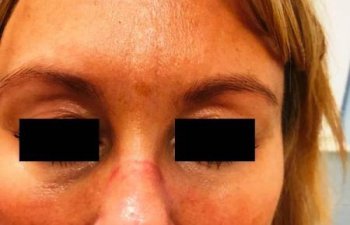 female patient before Restylane treatment for frown lines