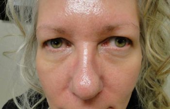 female patient before blepharoplasty