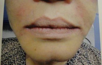 female patient before Juvederm treatment for nasolabial folds