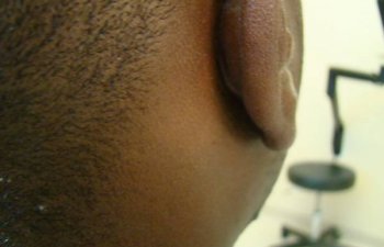 patient after ear keloid treatment