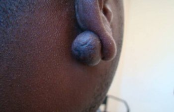 patient before ear keloid treatment