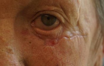 male patient after Mohs left lower eyelid surgery