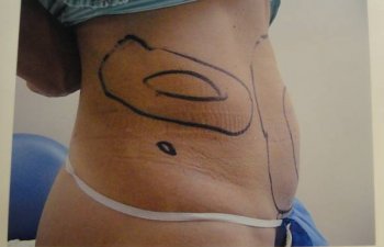 female patient before tumescent liposuction