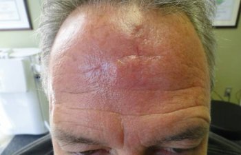 male patient after forehead Mohs surgery