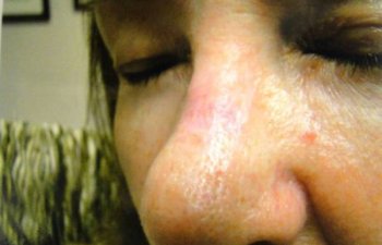 female patient after nasal bridge Mohs surgery