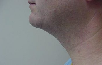 male patient after neck liposuction