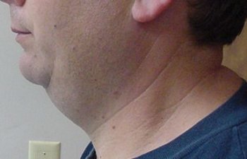 male patient before neck liposuction