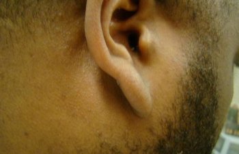 male patient after ear keloid treatment