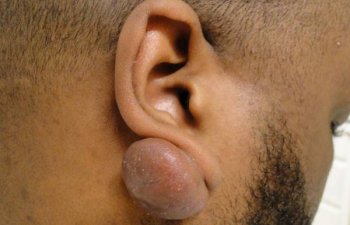 male patient before ear keloid treatment