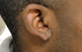 male patient after ear keloid treatment