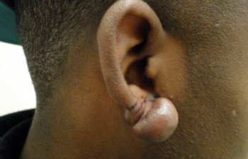 male patient before ear keloid treatment