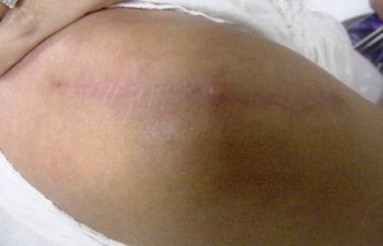 female patient after keloid treatment