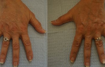 Hands of an old woman after a Radiesse filler