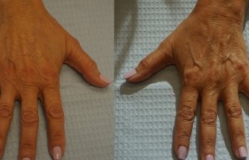 Hands of an old woman before a Radiesse filler