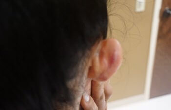 Keloid After