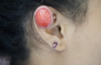 Keloid Before