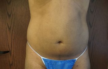 Patient Before Beautiful 360 Laser Liposuction