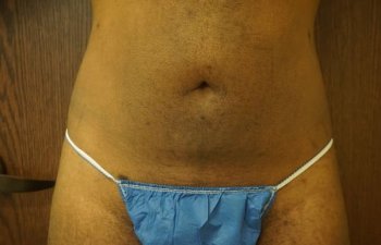 Patient After Beautiful 360 Laser Liposuction